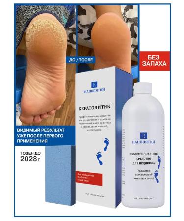 NANO-HEELS Pedicure remedy for rough skin on heels