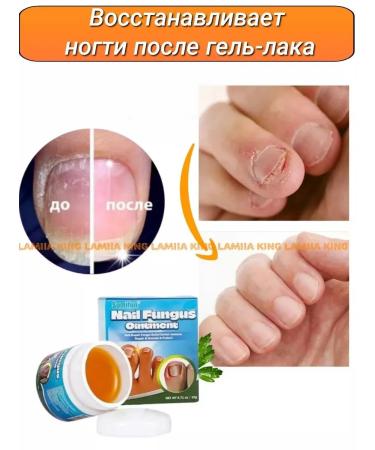 creams Chinese remedy for nail fungus 20 g - Buy Online on GoSupps.com