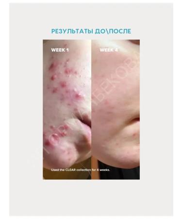 Paula's Choice Cream for problem skin - Buy Online on GoSupps.com