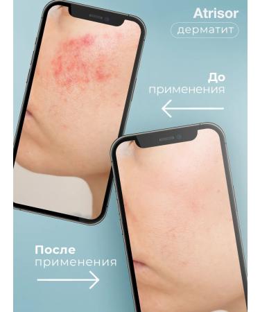 balace Atrisor Psoriasis cream for acne and dermatitis - Buy Online on GoSupps.com