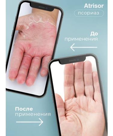 balace Atrisor Psoriasis cream for acne and dermatitis - Buy Online on GoSupps.com