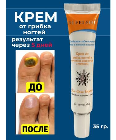 GlobalGoods Cream from nail fungus and skin lesions around