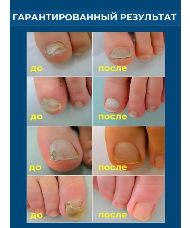 GlobalGoods Cream from nail fungus and skin lesions around - Buy Online on GoSupps.com