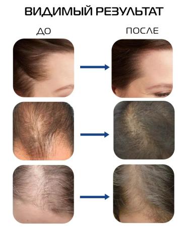 SeruZone Lotion for hair growth beard against hair loss - Buy Online on GoSupps.com