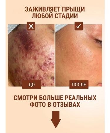 SeruZone Facial and body cream from acne with retinol - Buy Online on GoSupps.com