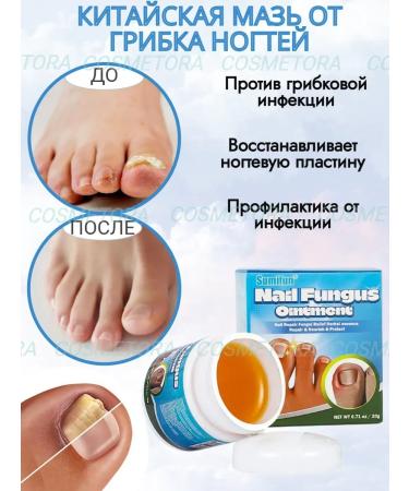 Chinese remedy for nail fungus