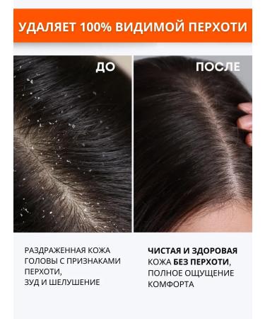 MousseEdge Sulsen hair dandruff shampoo - Buy Online on GoSupps.com
