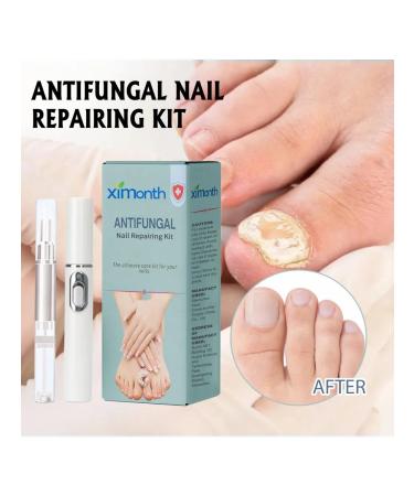 Ximonth antifungal set for nail care - Buy Online on GoSupps.com
