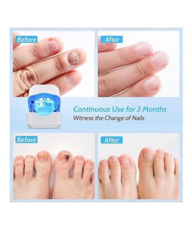 Nail fungus laser therapy device - Buy Online on GoSupps.com