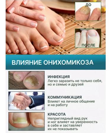 Essence Chinese remedy for nail fungus 30 ml - Buy Online on GoSupps.com