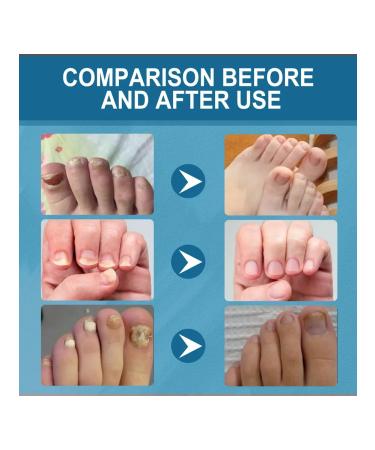 Fulgicide nail solution strengthens the nails - Buy Online on GoSupps.com