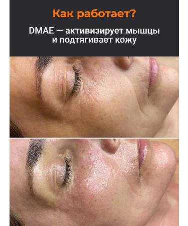 Fusion Mesotherapy DMAE serum 1% 5 10 ml for mesoroller and dermapen - Buy Online on GoSupps.com