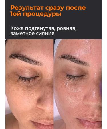 Fusion Mesotherapy DMAE serum 1% 5 10 ml for mesoroller and dermapen - Buy Online on GoSupps.com