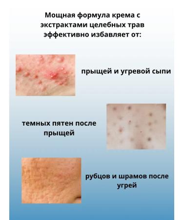 Aleng Facial cream from acne and dark stains - Buy Online on GoSupps.com