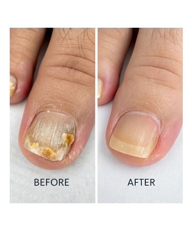 Unique Product Oil from nail fungus onycholysis and cuticle - Buy Online on GoSupps.com