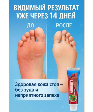 KEVO Ointment from the skin fungus between the fingers on the legs - Buy Online on GoSupps.com