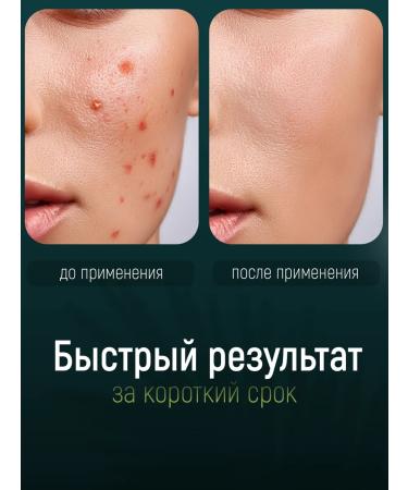 SKINTALE COSMETICS Anti-acne cream from anti-acne acne cream - Buy Online on GoSupps.com