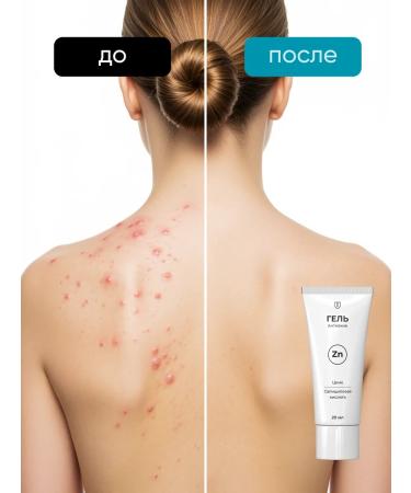 Althea Cream Corpriser Toutful against acne - Buy Online on GoSupps.com