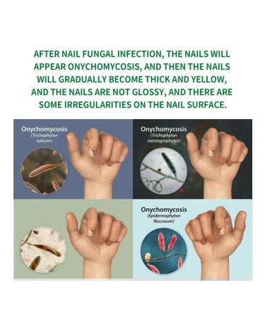 Solution for the treatment of nails with ginger jaysuing - Buy Online on GoSupps.com