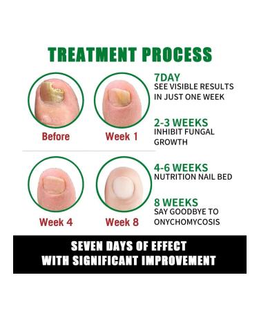 Solution for the treatment of nails with ginger jaysuing - Buy Online on GoSupps.com