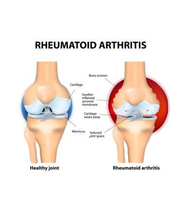 Joint cream (20g from pain and arthritis) - Buy Online on GoSupps.com
