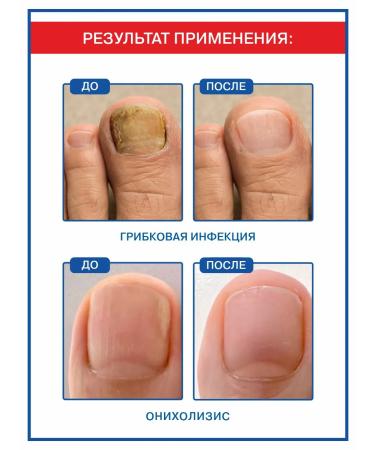 NANO-HEELS Fleet fungus cream on the legs from onycholysis thickening - Buy Online on GoSupps.com