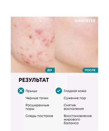 Chatterbox 100 ml for the face against acne and acne - Buy Online on GoSupps.com