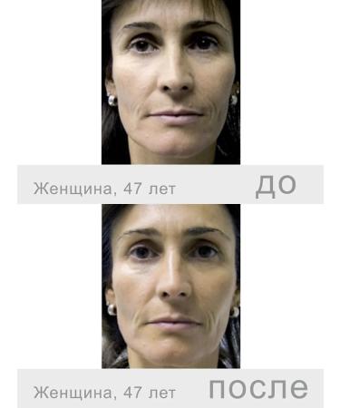 Fusion Mesotherapy F-XFC+ Peptide cocktail with a lifting effect 5 ml - Buy Online on GoSupps.com