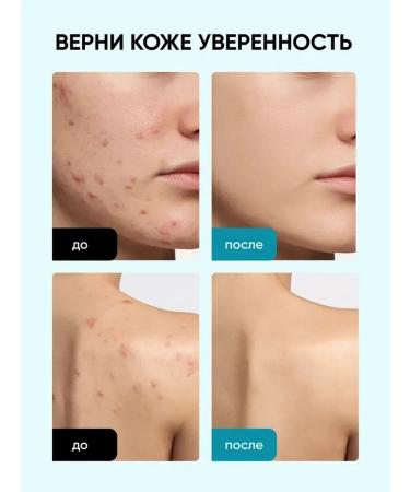 QEEP Acne cream and acne for the face and body - Buy Online on GoSupps.com