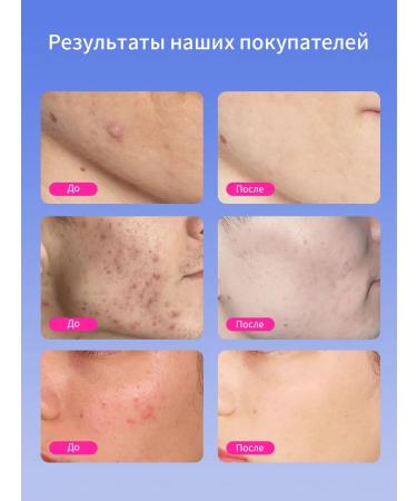 RUW Facial cream for acne with salicylic acid 50ml - Buy Online on GoSupps.com