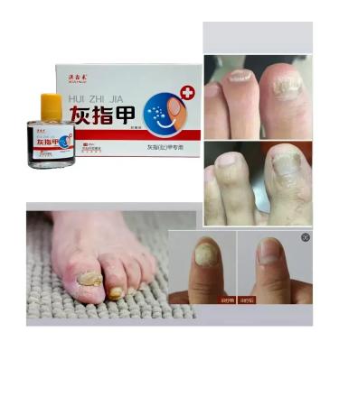 Chinese remedy for the treatment of nail fungus - Buy Online on GoSupps.com