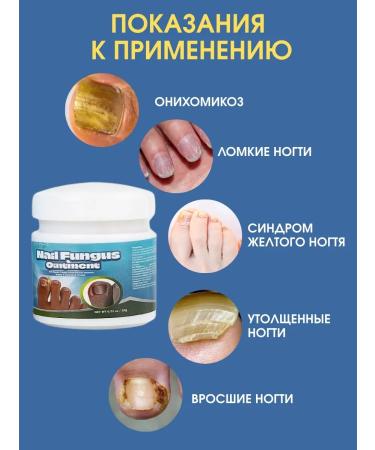 NazzShop Nail Fungus Ointment from the nail fungus on the legs ointment China - Buy Online on GoSupps.com