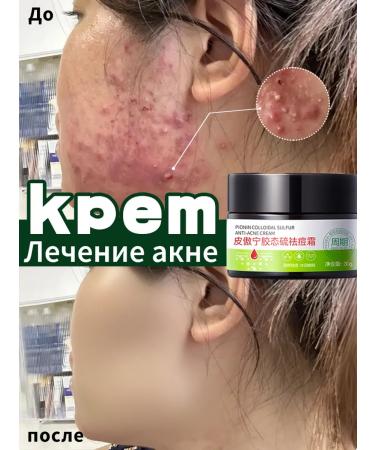 LYDIMOON Cream against acne 30g