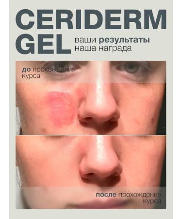 VIS MEDICUS Cream from scars and scars - Buy Online on GoSupps.com