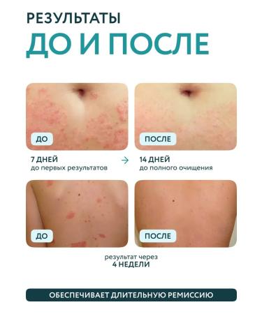 Restet A complex of creams from psoriasis and atopic dermatitis - Buy Online on GoSupps.com
