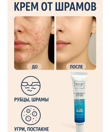RatiKarS Cream from stretch marks and scars scars and post -acne