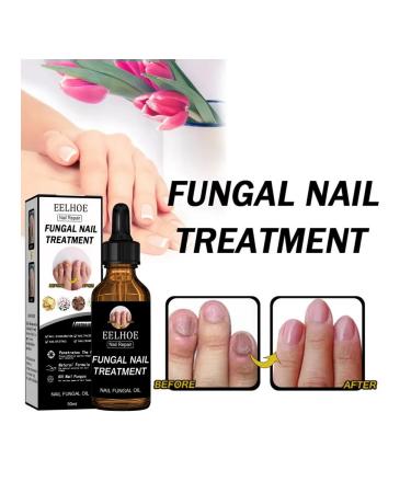Treatment of nail fungus recovery panthenol glycerin - Buy Online on GoSupps.com