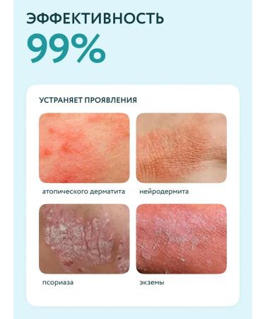 Restet Daily cream from psoriasis and atopic dermatitis - Buy Online on GoSupps.com