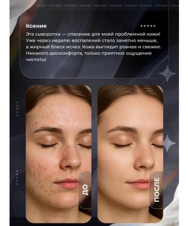 IKKI LV Facial cream from acne and post -acne serum - Buy Online on GoSupps.com