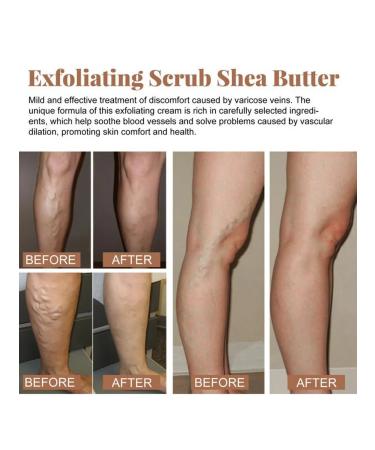 Body scrub from varicose veins (100 ml of exfoliation) - Buy Online on GoSupps.com