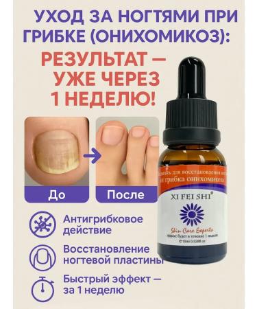 Remedy for nail and skin fungus restoration