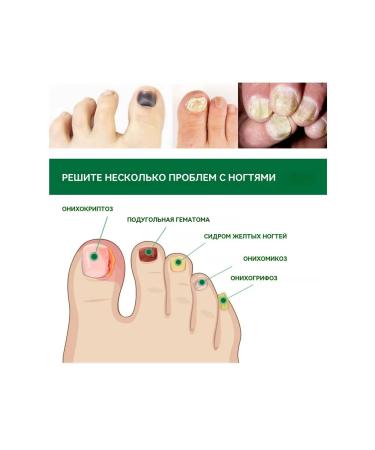 Essence to restore nails solution for treatment mushroom - Buy Online on GoSupps.com