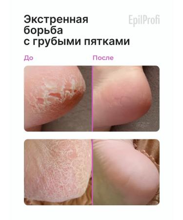 EpilProfi Keratolytic for heels with urea from cracks for pedicure - Buy Online on GoSupps.com