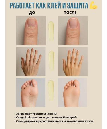 Multi Pasa Smart Master Treatment of Onicholysis - Buy Online on GoSupps.com