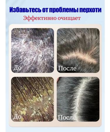 LYDIMOON Shampoo against dandruff with selenium disulfide 300 ml - Buy Online on GoSupps.com