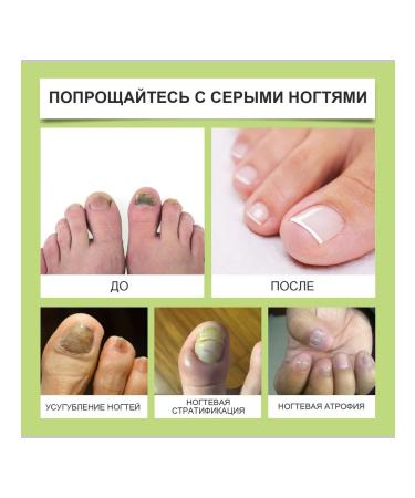 Sulfuries for nails improves the shape and health of the nail bed - Buy Online on GoSupps.com