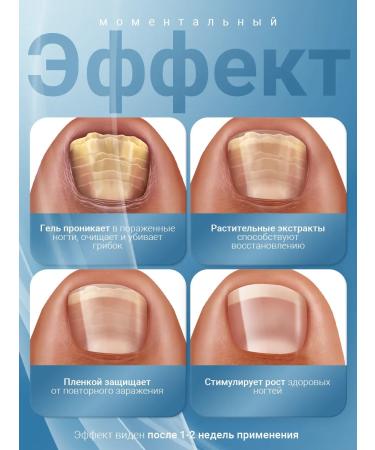 D'umor Dermatizone Ointment from nail fungus - Buy Online on GoSupps.com