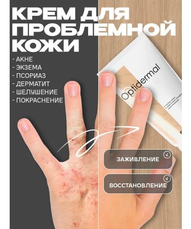 D'umor Ointment from psoriasis from acne and dermatitis