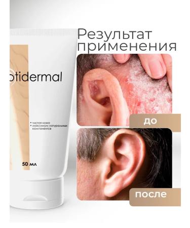 D'umor Ointment from psoriasis from acne and dermatitis - Buy Online on GoSupps.com