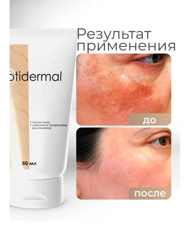 D'umor Ointment from psoriasis from acne and dermatitis - Buy Online on GoSupps.com